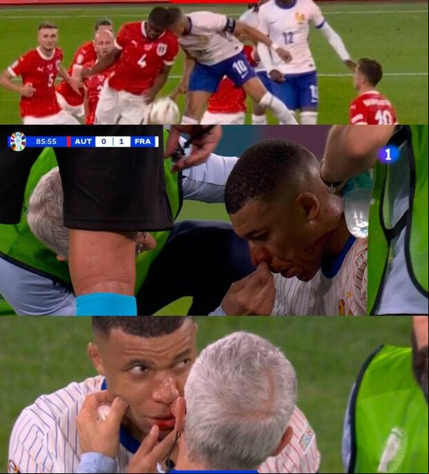 Lesión de Kylian Mbappé en la Eurocopa 2024. (Foto: X).