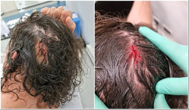 El terrible corte en la cabeza que sufrió Zlatan Ibrahimovic. (Instagram)