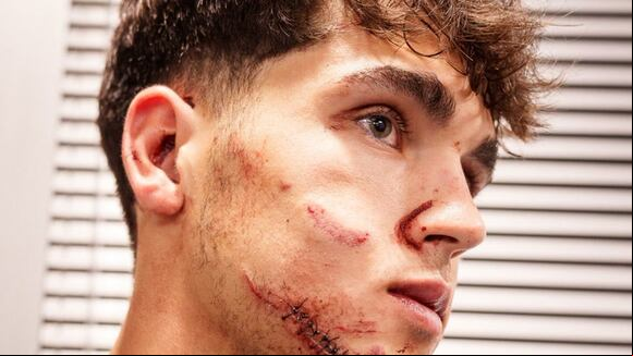 Así quedó el rostro de Pau Cubarsí tras la sutura de puntos.
